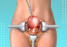 Hysterectomy Surgery